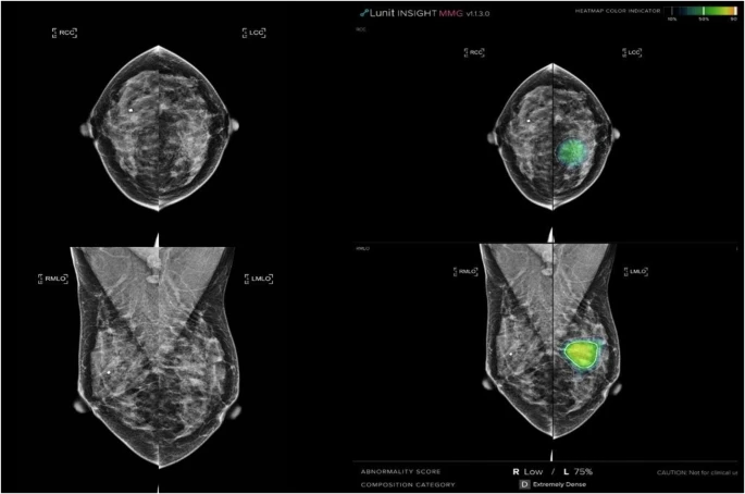 AI in Radiology