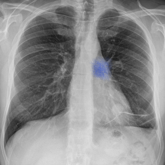 X-ray with AI detection