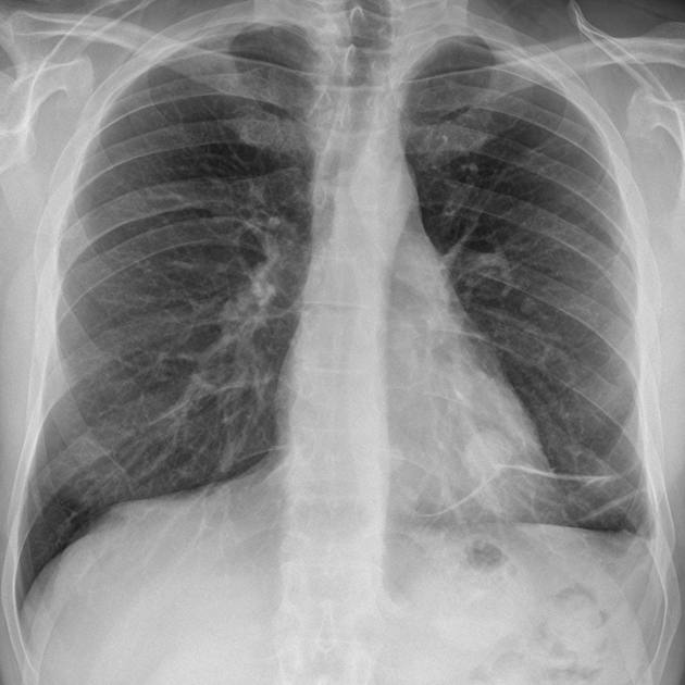  CXR with AI
                                detection